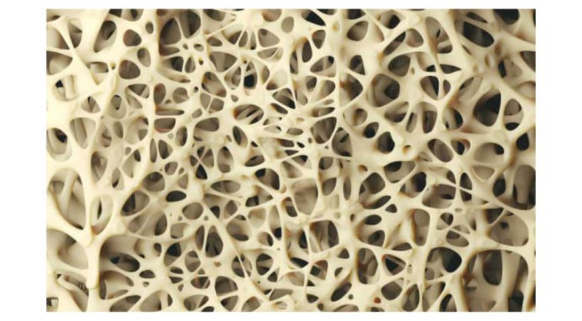 Efecto de la osteopenia y la osteoporosis en el fracaso de primeros y segundos implantes dentales