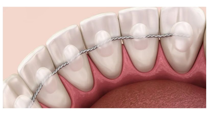 Composición, resistencia a la corrosión y propiedades mecánicas de retenedores fijos CAD -CAM  versus convencionales
