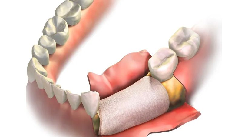 Desafíos e innovaciones en la regeneración ósea alveolar