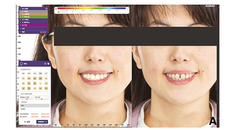 Aplicación del diseño de sonrisa digital 3D basado en análisis de articulación virtual en odontología estética