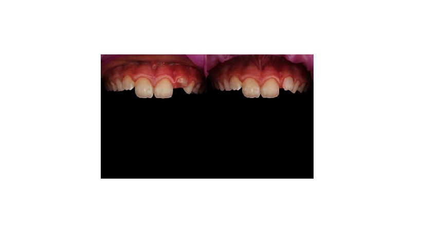 Manejo eficaz de un diente fracturado en un niño mediante una corona pediátrica estética