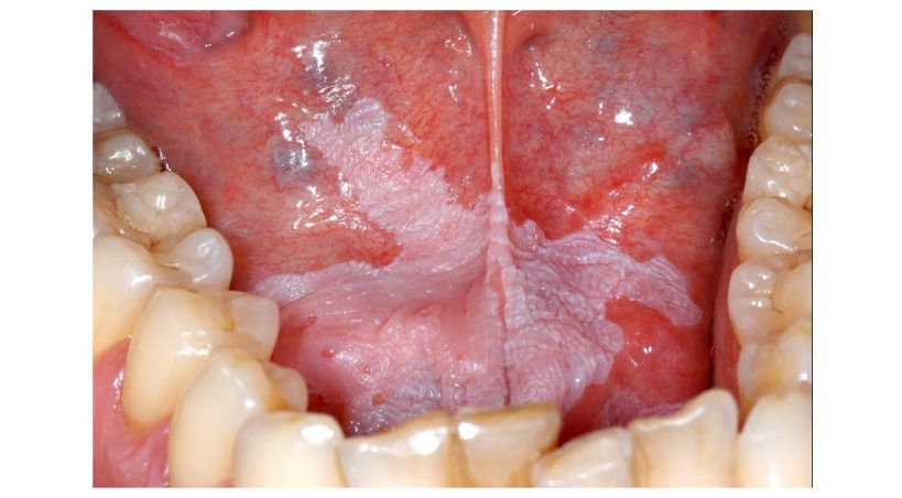 Actualización sobre el Manejo Clínico de la Leucoplasia Oral