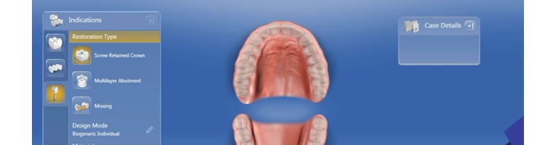 Rehabilitación con odontología digital sobre implantes integrando sistema TiBase