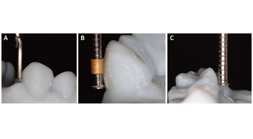 Levantamiento digital versus convencional para arcadas parcialmente desdentadas: una evaluación de la precisión y la eficiencia en el tiempo