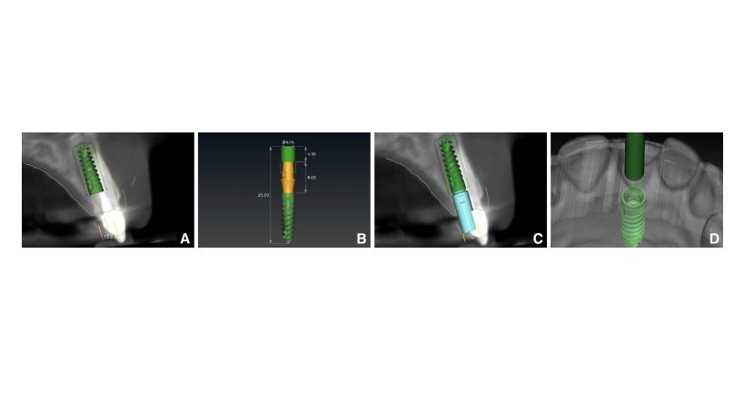 Colocación inmediata de una corona provisional atornillada sobre implante previamente fabricada, utilizando la posición del implante determinada en l
