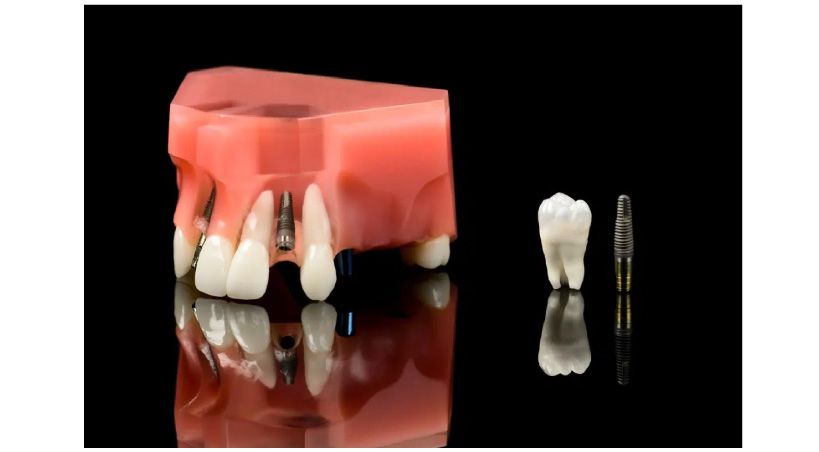 Terapia con Implantes Dentales en Pacientes con Enfermedades Autoinmunes